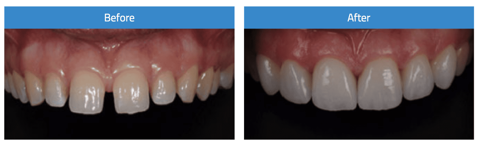 Before and after dental veneers